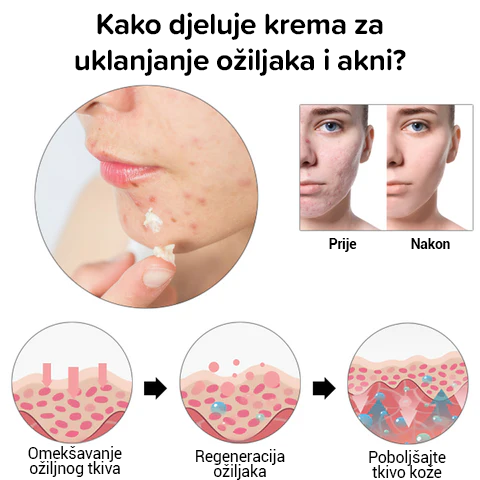 Kreme za uklanjanje ožiljaka od akni i ožiljaka