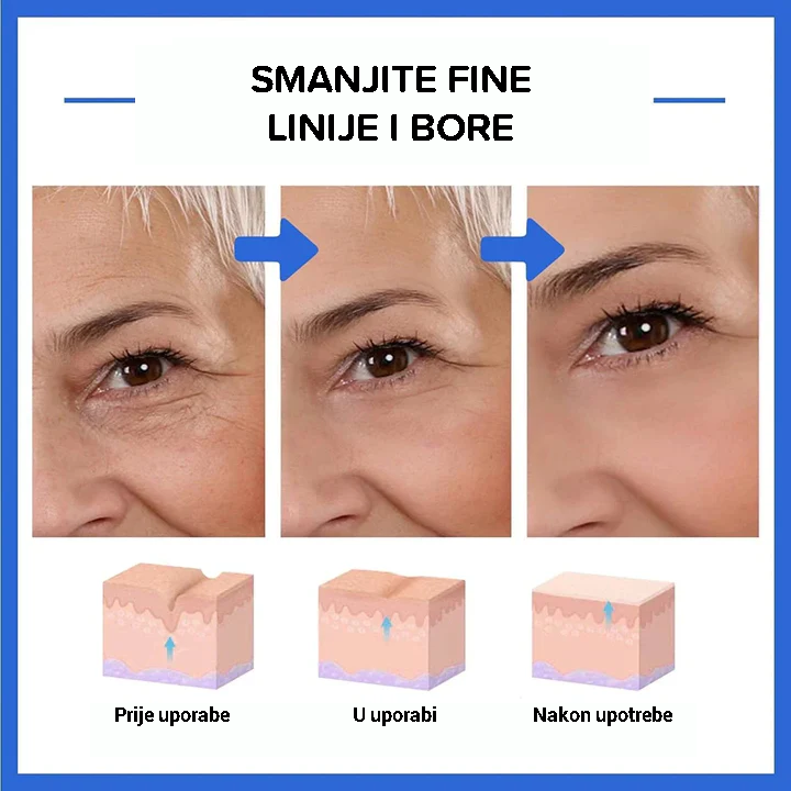 Botulinum serum za lice