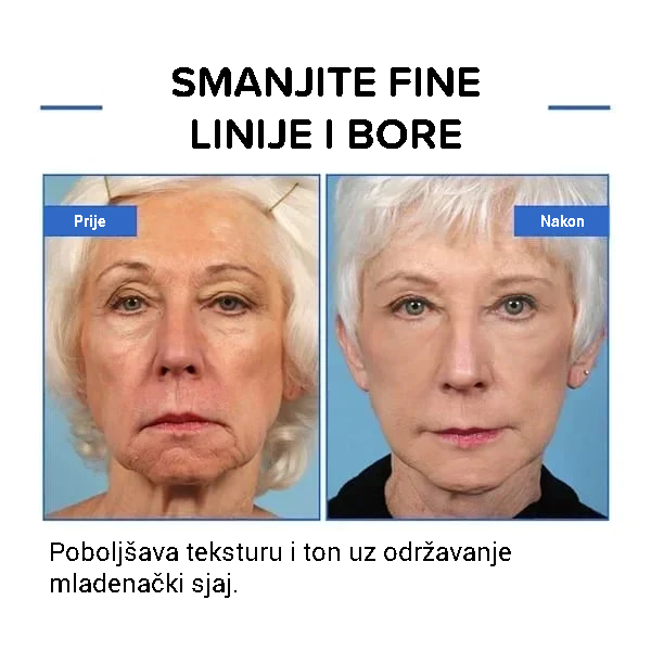 Botulinum serum za lice