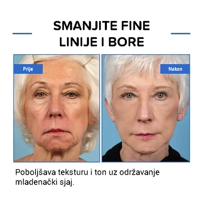 Botulinum serum za lice