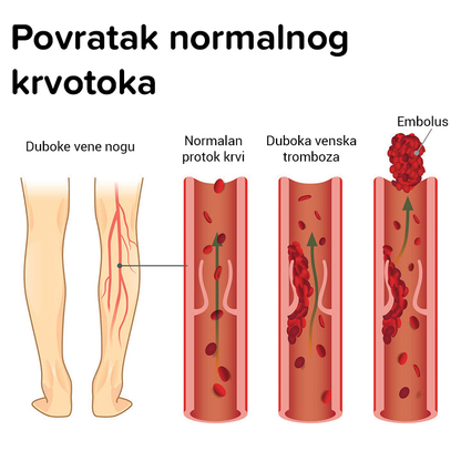 Sprej za liječenje proširenih vena