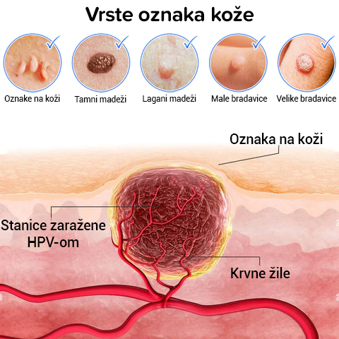 Krema za mrtvu kožu, mrlje i bradavice ((2024))